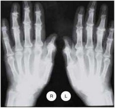 Рис. 9.2. Рентгенограмма кистей. Определяется сужение рентгенологических суставных щелей. Субхондральный склероз, остеофиты в ДМФС и ПМФС
