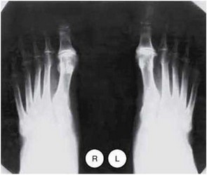 Рис. 9.3. Рентгенограмма стоп. Определяется сужение суставных щелей. Субхондральный склероз и краевые остеофиты в ПФС 1-х пальцев стоп.