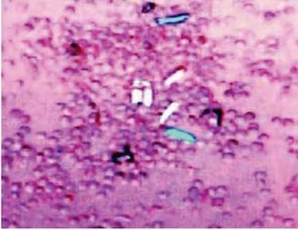 Рис. 16. Выявление и идентификация кристаллов пирофосфата кальция при микроскопии в поляризованном свете