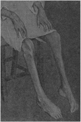 Рис. 12. Паралич ног у больного бери-бери (Япония)