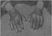 Рис. 14. Поражение кожи рук при пеллагре (США)