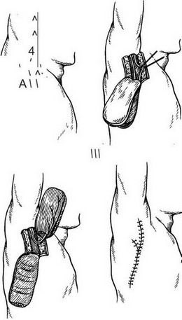 Рис. 7. Сосудистый пучок и схема выкраивания торакодорсального лоскута.