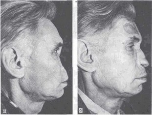 Рис. 40. Тотальный дефект носа. а-внешний вид больного до операции; б-после восстановления носа
				лоскутами со лба.