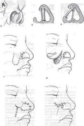 Рис. 42. Схема устранения сквозного дефекта крыла носа лоскутами из носогубной складки и из перегородки носа