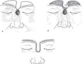 Рис. 43. Схема устранения частичных дефектов верхней трети носа скользящими лоскутами со лба.