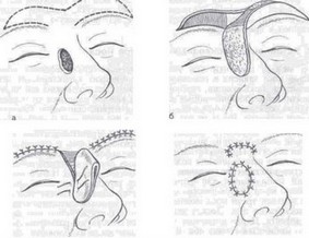 Рис. 44. Схема устранения сквозного дефекта носа двухлепестковым лоскутом со лба.