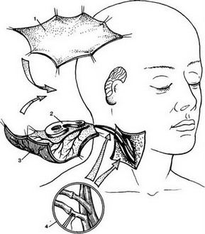 Рис. 49. Схема одномоментного формирования ушной раковины фасциальным аутотрансплантатом.