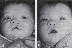 Рис. 81. Односторонняя неполная расщелина верхней губы, альвеолярного отростка
			и деформация носа I степени у ребенка 4 мес.