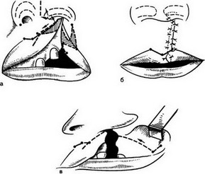 Рис. 82. Первичная хейлопластика (ринохейлопластика) по Лимбергу при односторонних расщелинах верхней губы.
