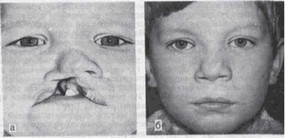 Рис. 87. Правосторонняя полная расщелина верхней губы, альвеолярного отростка и неба с деформацией носа III степени у ребенка 7 мес, а-до операции; б через 5 лет после операции.