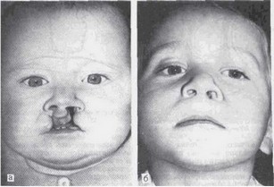 Рис. 89. Двусторонняя асимметричная расщелина верхней губы, альвеолярного отростка и неба с деформацией II степени у ребенка 6 мсс. а-до операции; б-чере:1 7 лет после операции.
