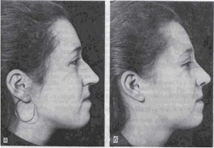 Рис. 102. Удлиненный нос. а-внешний вид пациентки до операции; б- после операции.