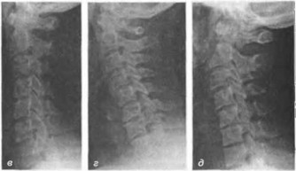 Рис. 21. Рентгенограммы шейного отдела позвоночника пациентов с синдромом вертебрально-базилярной недостаточности