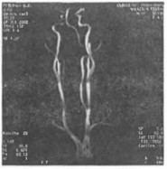 Рис. 23. Магнитно-резонансная ангиография: гипоплазия правой позвоночной артерии; патологическая извитость обеих внутренних сонных артерий