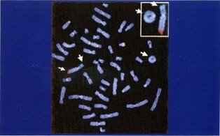 Рис. 10. Гибридизация хромосом человека с генами-зондами, мечеными красным и зеленым флюоресцентными красителями.