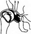 Рис. 41 Артрогрсмма тазобедренного сустава при врождённом вывихе бедра 1 - головка бедренной кости; 2 - лимбус; 3 - суставного хрящ.