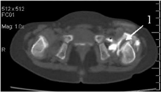 Рис. 56. КТ скан на уровне центра вертлужной впадины у ребенка с 2-х сторонним врожденным вывихом бедра.
