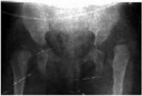 Рис. 72. Рентгенограмма больного Акбота до лечения.