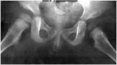 Рис. 74. Контрольная рентгенограмма больного Акбота через год после лечения