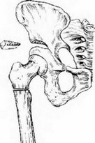Рис. 104 Ацетабулопластика с дополнительного остеотомией лонной кости.
