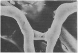 Рис. 7. Венуло-венулярный анастомоз. Коррозионный препарат микрососудов пульпы зуба собаки (электронная микроскопия).X 1600.