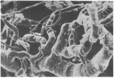 Рис. 12. Микроварикозность и извилистость микрососудов. Острый гнойный пульпит, коронковая пульпа