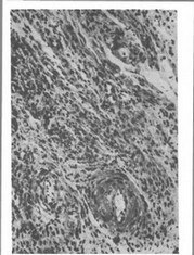 Рис. 23. Фиброзные изменения ткани коронковой пульпы, деструктивные повреждения стенок микрососудов. Хронический фиброзный пульпит. X 200.