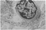 Рис. 25. Лимфоцит в составе экссудата в коронковой пульпе. Хронический фиброзный пульпит.