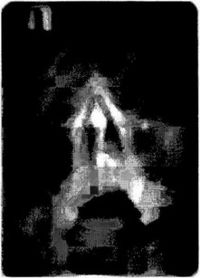 Рис. 2-1. Рентгенограмма придаточных пазух носа. Слепое огнестрельное ранение верхней челюсти слева.