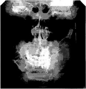 Рис. 9-4 Рентгенограмма черепа в прямой проекции.