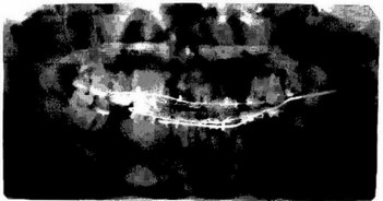 Рис. 9-9. Панорамная рентгенограмма. Односторонний двойной перелом нижней челюсти в области угли и клыка слева.
