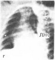 Рис. 3. Рентгенограмма грудной клетки в различных проекциях.