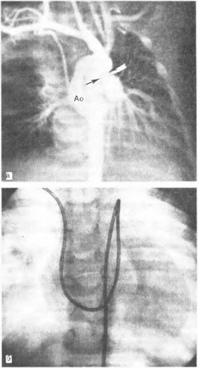 Рис. 6. Аортограмма при открытом артериальном протоке.