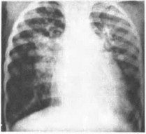 Рис. 22. Рентгенограмма грудной клетки. Дефект межжелудочковой перегородки с реакцией Эйзенменгера.