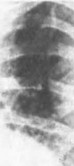 Рис. 37. Атрезия легочной артерии с дефектом межжелудочковой перегородки. Рентгенограмма грудной клетки.