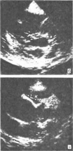 Рис. 38. Атрезия легочной артерии с дефектом межжелудочковой перегородки. Эхокардиограмма.