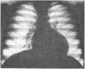 Рис. 43. Клапанный стеноз аорты. Рентгенограмма грудной клетки. Объяснение в тексте.