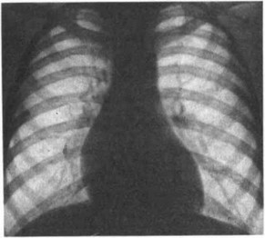 Рис. 46. Рентгенограмма грудной клетки больного 8 лет с коарктацией аорты.