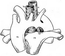 Рис. 47. Схема анатомического расположения аорты, пищевода и трахеи при двойной дуге аорты.
