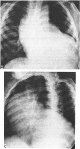 Рис. 49. Аортскпевожелудочковый туннель. Рентгенограмма грудной клетки, а — прямая проекция, б — вторая косая проекция.