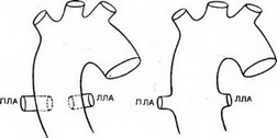 Рис. 65. Варианты общего артериального ствола (схема).