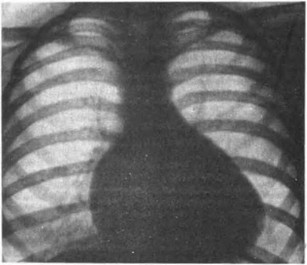 Рис. 69. Аномалия Эбштейна. Рентгенограмма грудной клетки. Объяснение в тексте.