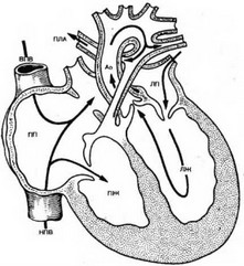 Рис. 73. Атрезия легочной артерии с интактной межжелудочковой перегородкой (схема).