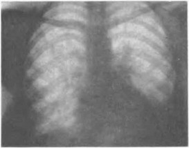 Рентгенограмма грудной клетки больного П. Дефект межпредсердной перегородки. 