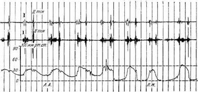 Рис. 74. Фонограмма (две верхние кривые) н кривые давления в полостях сердца, записанные при зондировании.