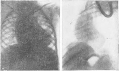 Рис. 102. Рентгенограмма больной Н. в двух проекциях. Диагноз: атрезия левого венозного отверстия.