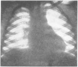 Рис. 104 Рентгенограмма больного Н. Диагноз: врожденный стеноз аорты. Значительное увеличение левом желудочка