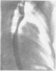Рис. 168. Контрастная рентгенограмма пищевода.