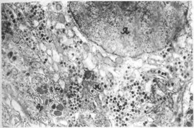 Рис. 6. Электронограмма гонадотропоцита аденогипофиза крысы-самки, получавшей амизил. Число секреторных гранул меньше, чем в контроле, цистерны эндоплазматического ретикулума расширены.