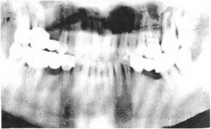 Рис. 24. Локализованный пародонтит при некачественном мостовидном протезировании. Резорбция И-Ill степени и остеопороз межзубных перегородок в области моляров. Атрофия и остеосклероз альвеолярной кости в области нижних фронтальных зубо